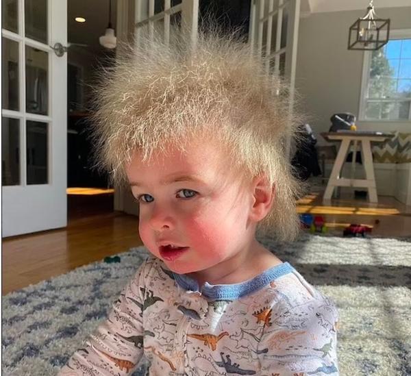 بیماری عجیب یک پسربچه؛ سندرم موی غوطه ور!